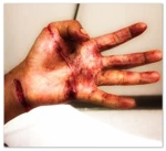 Maryanna's hand after attack by a 7 lb. monkey