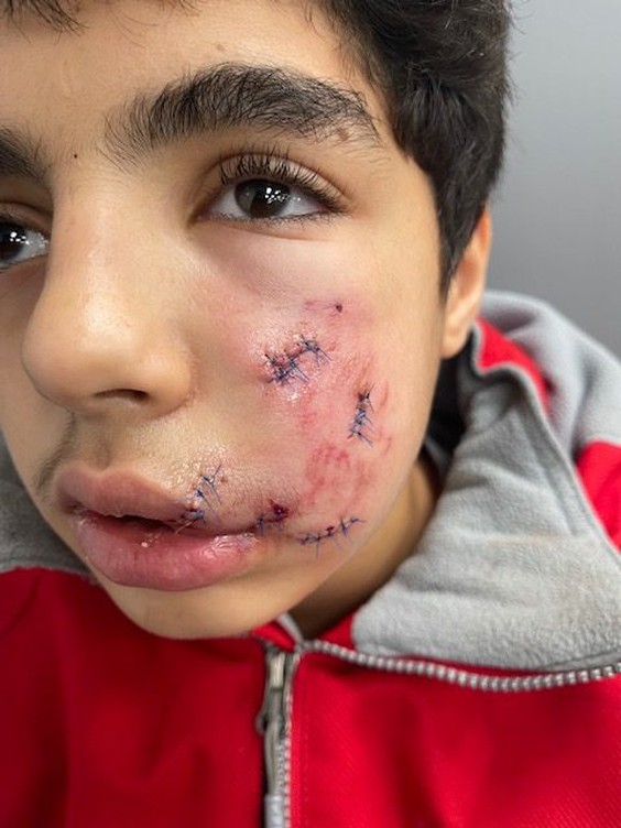 13-year-old Muhammad Almutaz Alzghool attacked by dog